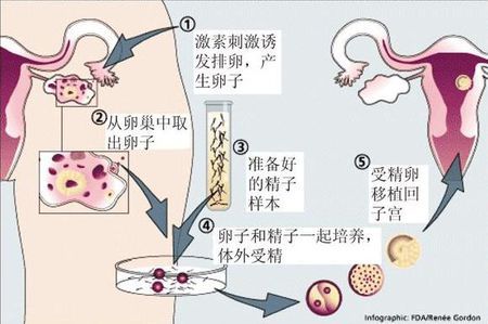 靠谱志愿者供卵咨询